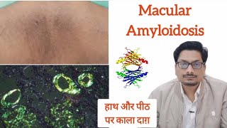 Macular Amyloidosis  हाथ और पीठ पर काला दाग़ Lichen Amyloidosis Biphasic Amyloidosis pigmentation [upl. by Lokim]