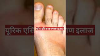 यूरिक एसिड का रामबाण इलाज  uric acid home remedy shorts shortvideos youtubeshorts uricacid [upl. by Suedaht]