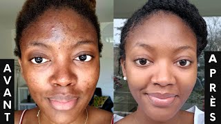 L ACNÉ COMMENT s en DÉBARRASSER 3 PRODUITS contre les boutons et les tâches🔥  SKINCARE ROUTINE💦 [upl. by Malvia]