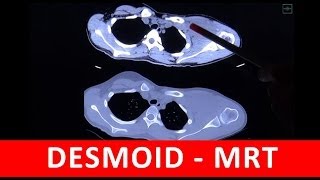 Desmoid  CT und MRT Analyse  by Radiologie TV [upl. by Alicia796]