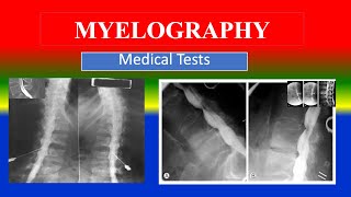 MYELOGRAPHY  Medical Tests  What is   Uses  Need  Preparation  Results [upl. by Malchus]