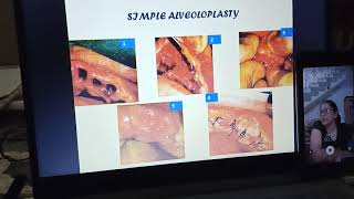 Preprosthetic surgery lecture part 1 [upl. by Sidoeht]