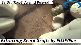 Know How to Extract Beard Grafts by FUSEfue [upl. by Pirzada817]