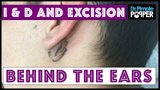 Inflamed and NonInflamed Cyst Removals Behind Ears [upl. by Saied]