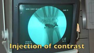 Wrist Arthrogram [upl. by Syned231]