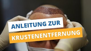 Krusten entfernen nach Haartransplantation ►Anleitung zur Krustenentfernung ◄ [upl. by Zakaria]