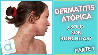 DERMATITIS ATÓPICA 😳 ¿Solo son ronchitas 🤔 [upl. by Caressa]