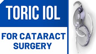 Toric IOL For Cataract Surgery [upl. by Ateerys]