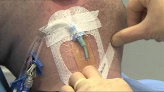 3M™ Tegaderm™ CHG IV Dressing 1657R Application and Removal Video CVC [upl. by Mcgrath]