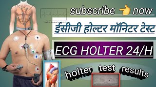 ecg holter monitor test  holter test results  holter monitor 24 hoursheart holter testviral [upl. by Sapienza]