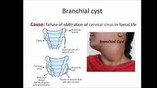 Branchial cyst [upl. by Lebezej]