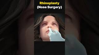 Rhinoplasty [upl. by Valtin]