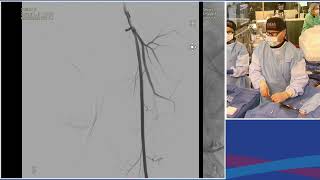 Live Case Presentation 5 Aortoiliac Bifurcation CTO Intervention Metzger Session V Artoiliac Dis [upl. by Sweeney]