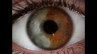 Cataract Surgery in Sectoral Heterochromia Iridis [upl. by Rossing513]