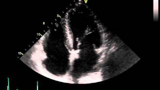 AORTOMITRAL VALVE CALCIFICATION CHRONIC KIDNEY DISEASE [upl. by Aerdnwahs492]