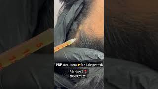 PRP treatment for boosting hair growth ✨️ [upl. by Pansie]