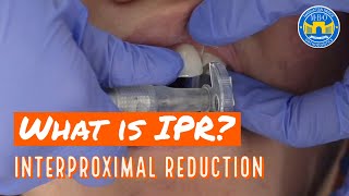 Interproximal Reduction IPR on Teeth for Braces and Invisalign [upl. by Najib]