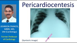 Pericardiocentesis [upl. by Idnaj]