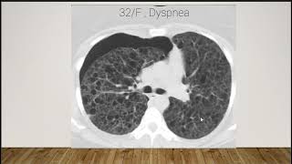 Case Discussion  Lymphangioleiomyomatosis LAM [upl. by Nithsa]