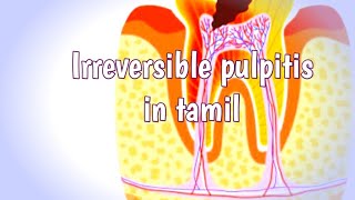 Irreversible pulpitis in tamilpulpitisflowerpot1564 [upl. by Ralph475]