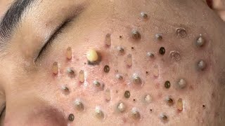 ACNE TREATMENT VU QUYNH MI Blackheads Removal Popping [upl. by Jefferson456]