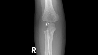 Elbow Joint Anatomy anatomy revision with questions and answers [upl. by Kemp]