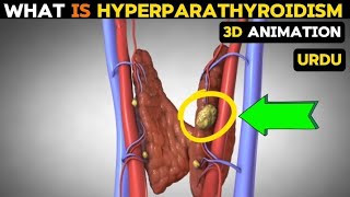 What is hyperparathyroidism causessymptoms and treatment [upl. by Iaverne]