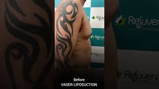 6 Pack Liposuction Before and After  No Scar Result  Rejuvena Cosmo Care Jaipur  Dr Deepesh Goyal [upl. by Lyontine]