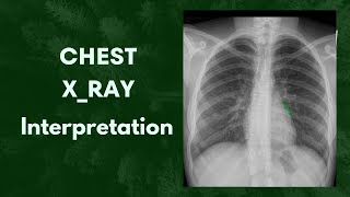 What is this called Chest X ray Interpretation 🤔anatomy youtube radiology [upl. by Annaohj]