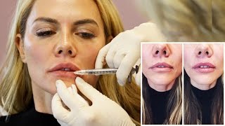 Natural Lip Injection Experience and Botox from Doctor Cynthia Cote [upl. by Karolyn]