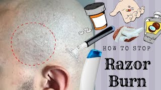 HOW TO STOP RAZOR BUMPSBURN Head Shave [upl. by Conal]