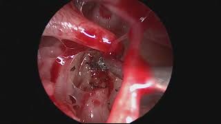 Endoscopic Congenital Stapes Footplate Fixation [upl. by Assenad]