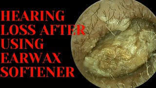 Hearing LOSS After Using Earwax Softener [upl. by Stamata857]