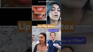 botox lip flip before and after [upl. by Snowber]