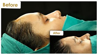 Ankitas Forehead Reduction Journey l Dr Cengizhan Ekizceli [upl. by Fronnia728]