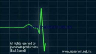 ECG Animation and Ventricular Fibrillation [upl. by Danny]