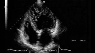 echocardiogram  LV Non compaction [upl. by Eikcid]