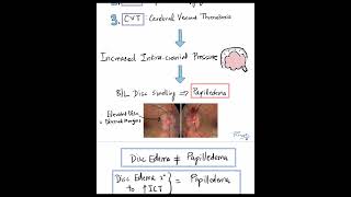 The 3 Important Causes of Papilledema Shorts [upl. by Amo]