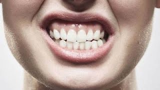 BRUXISMO RECHINAR LOS DIENTES CAUSAS SÍNTOMAS Y TRATAMIENTO [upl. by Eelnayr594]