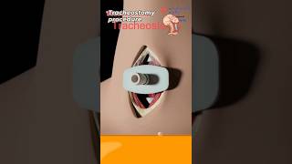 What is tracheostomy procedure 🧐 sorts [upl. by Shull902]