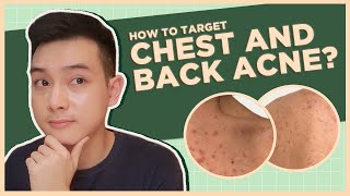 Get rid of CHEST amp BACK ACNE BEST PRODUCTS  DOs and DONTs Filipino  Jan Angelo [upl. by Nerrat]