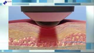 Deep Tissue Laser Therapy The Science Behind Healing [upl. by Eimmak]