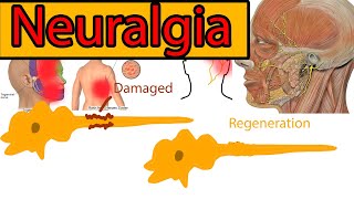 Neuralgia Explained under 3 minutes Trigeminal Neuralgia symptoms and treatment [upl. by Normalie]