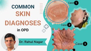 Common Skin Diagnoses In OPD [upl. by Macfarlane]