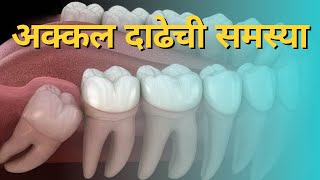 अक्कलदाढ काढणे आवश्यक आहे का  Wisdom Tooth Problems  इम्पैक्टेड दात  Impacted Tooth Marathi [upl. by Wendelin]