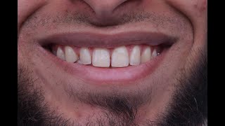 Multiple diastema closure with composite resin [upl. by Newbold]