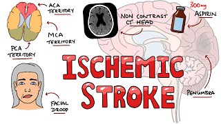 Acute Ischemic Stroke  Signs and Symptoms Stroke Syndromes  Causes amp Mechanisms  Treatment [upl. by Mathilde]