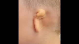 Microtia Awareness Day 👂🦻microtiaawarenessday speechandhearing hearingaids speechtherapy [upl. by Marlo408]