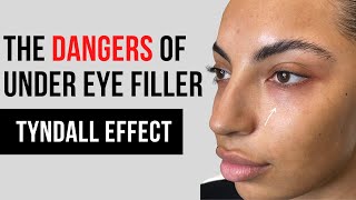 BOTCHED Under Eye Filler Gone Wrong  Tear Trough Tyndall Effect [upl. by Oinota]