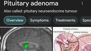 Pituitary MacroAdenoma Large sized 64x45x61 mm responded by Dr Arpit Chopra Jain Modern Homoeopathy [upl. by Ragouzis]